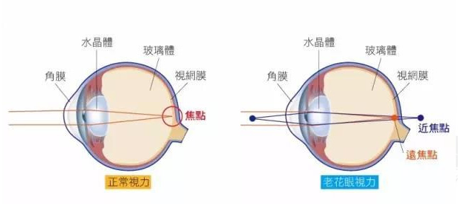 白內(nèi)障和老花眼區(qū)別，老花眼發(fā)病率正呈現(xiàn)年輕化趨勢(shì)