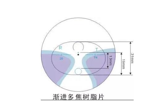 美麗島多焦鏡適合的人群，需要注意的事項(xiàng)